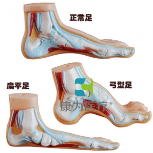 “康為醫(yī)療”正常足、扁平足、弓型足模型